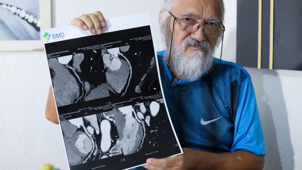 DPE-AM garante cirurgia cardíaca para homem que estava com 90% do coração comprometido